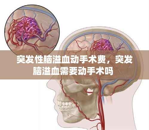 突发性脑溢血动手术费,突发脑溢血需要动手术吗
